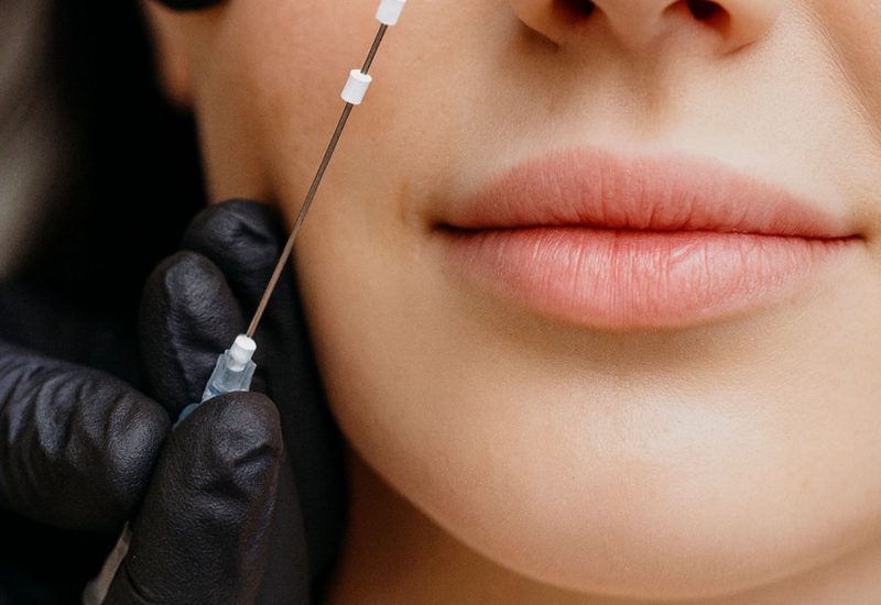 PDO Thread Lift Naples FL